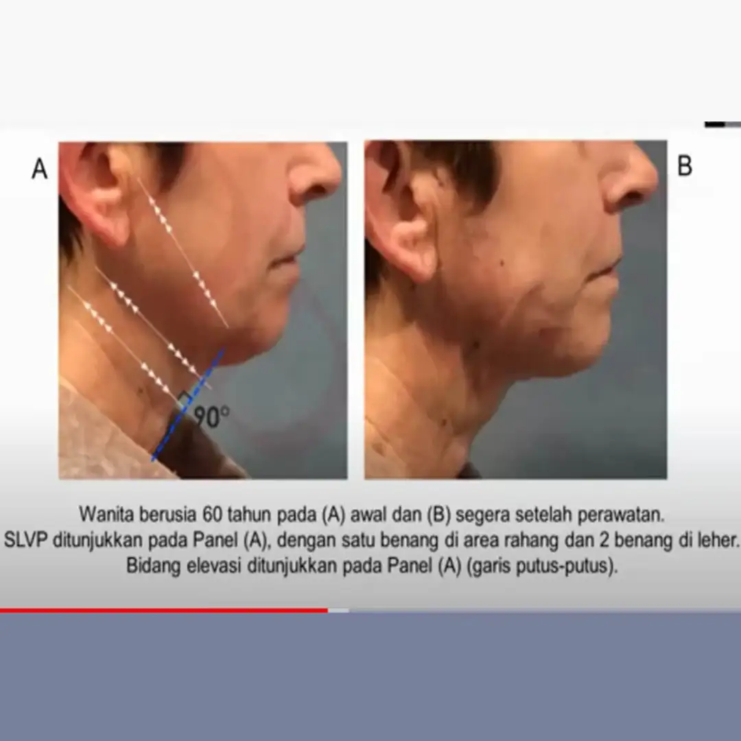 Webinar SIlhouette Soft Injection Technique