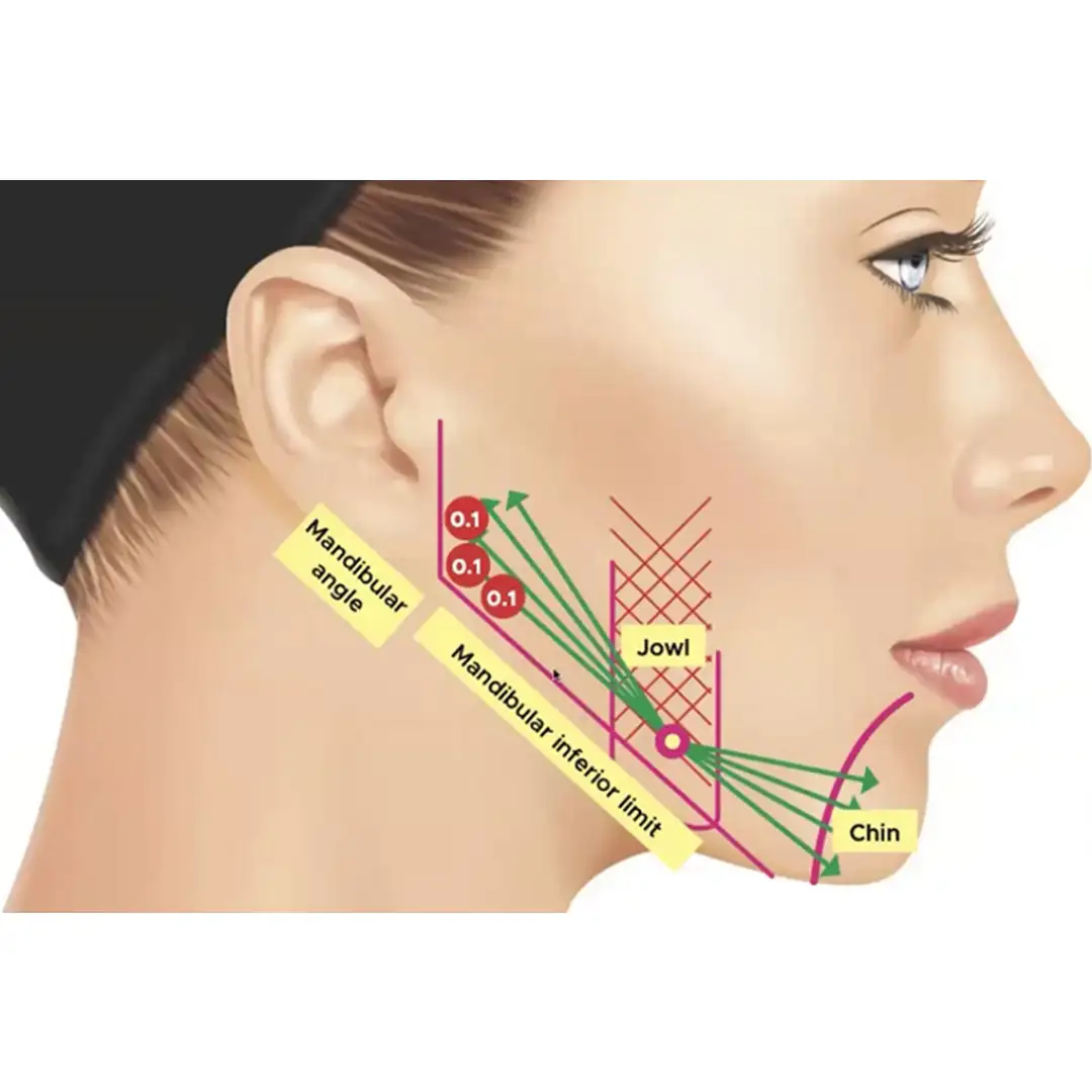 A Safe and Effective Dual Action Treatment for Instant Lifting and Collagen Stimulation with Ellanse