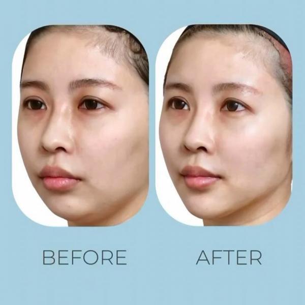 Thread Lift atau Filler?